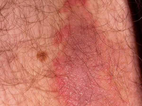 Infecção Pele Fúngica Coxa Masculina — Fotografia de Stock