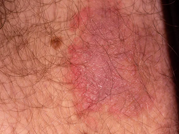 Erkek uylukta mantar deri enfeksiyonu