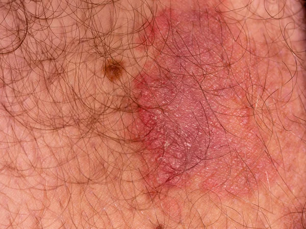 Erkek uylukta mantar deri enfeksiyonu