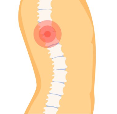 İnsan omurga Poster kemik üzerinde kırmızı nokta ile ağrı