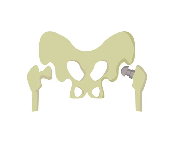 Pelvis and Metal Prosthesis Vector Illustration — Stock Vector