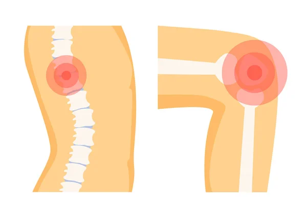 Ensemble de douleurs orthopédiques de la colonne vertébrale, illustration vectorielle — Image vectorielle