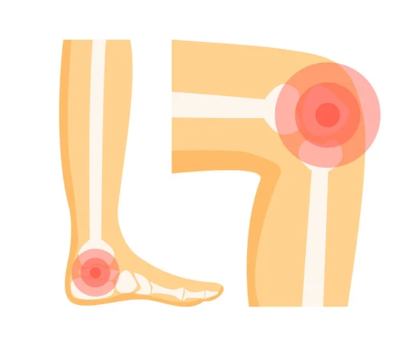 Problemas ortopédicos en el pie Vector Ilustración — Archivo Imágenes Vectoriales