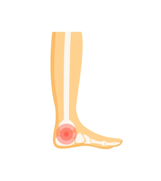 Fußschmerzen menschlicher Körper Krankheitsvektor Illustration — Stockvektor