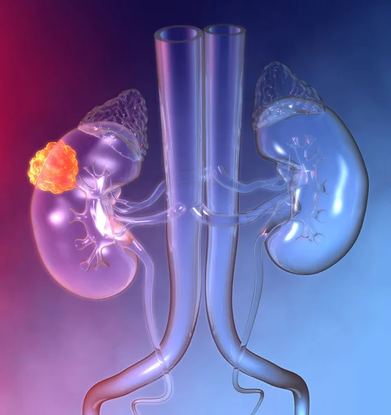 Kidney cancer, colorful medically 3D illustration — Stock Photo, Image