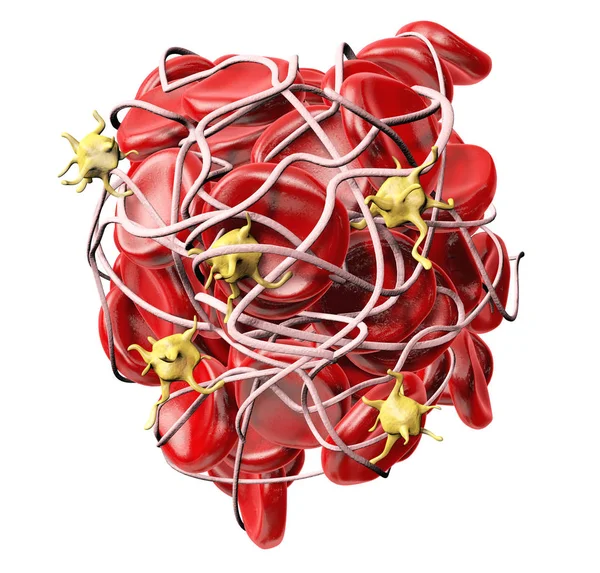 Trombo, coágulo sanguíneo con plaquetas activadas y fibrina, ilustración médicamente 3D — Foto de Stock