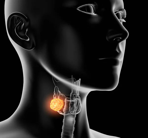 Рак щитовидной железы у женщины, медицинская 3D иллюстрация на черной ба — стоковое фото