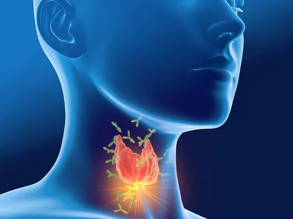 Антитела атакуют щитовидную железу женщины, аутоиммунный тиро — стоковое фото