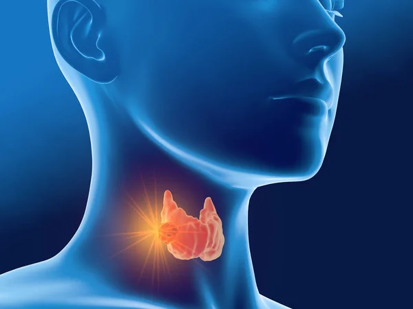 Рак щитовидной железы у женщины, медицинская 3D иллюстрация, вид спереди — стоковое фото