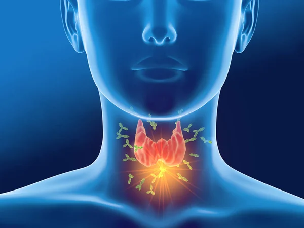 Antibodies attacking thyroid gland of a woman,  Autoimmune thyroiditis, Hashimoto's disease. — Stock Photo, Image