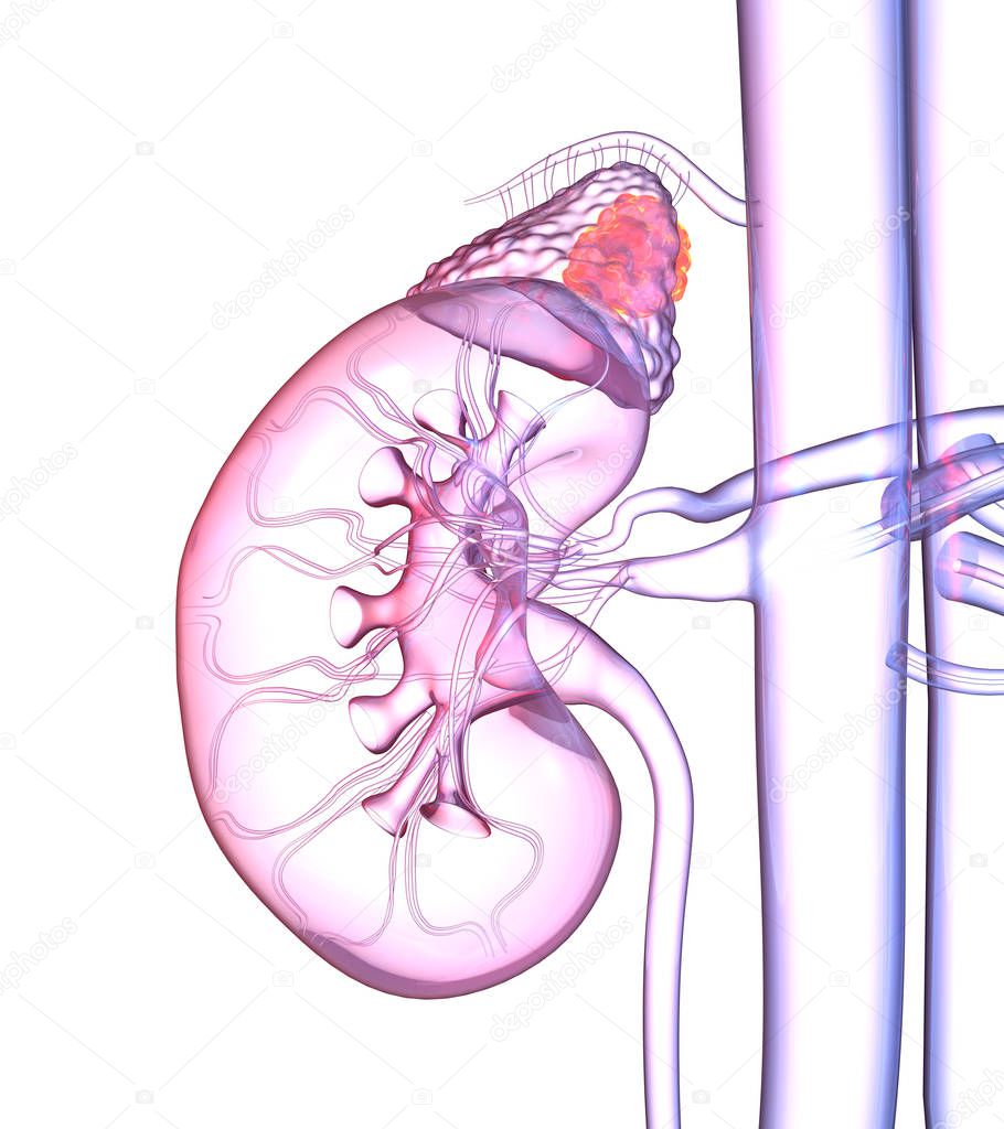 Adrenal glands tumor, colorful medically 3D illustration on whit