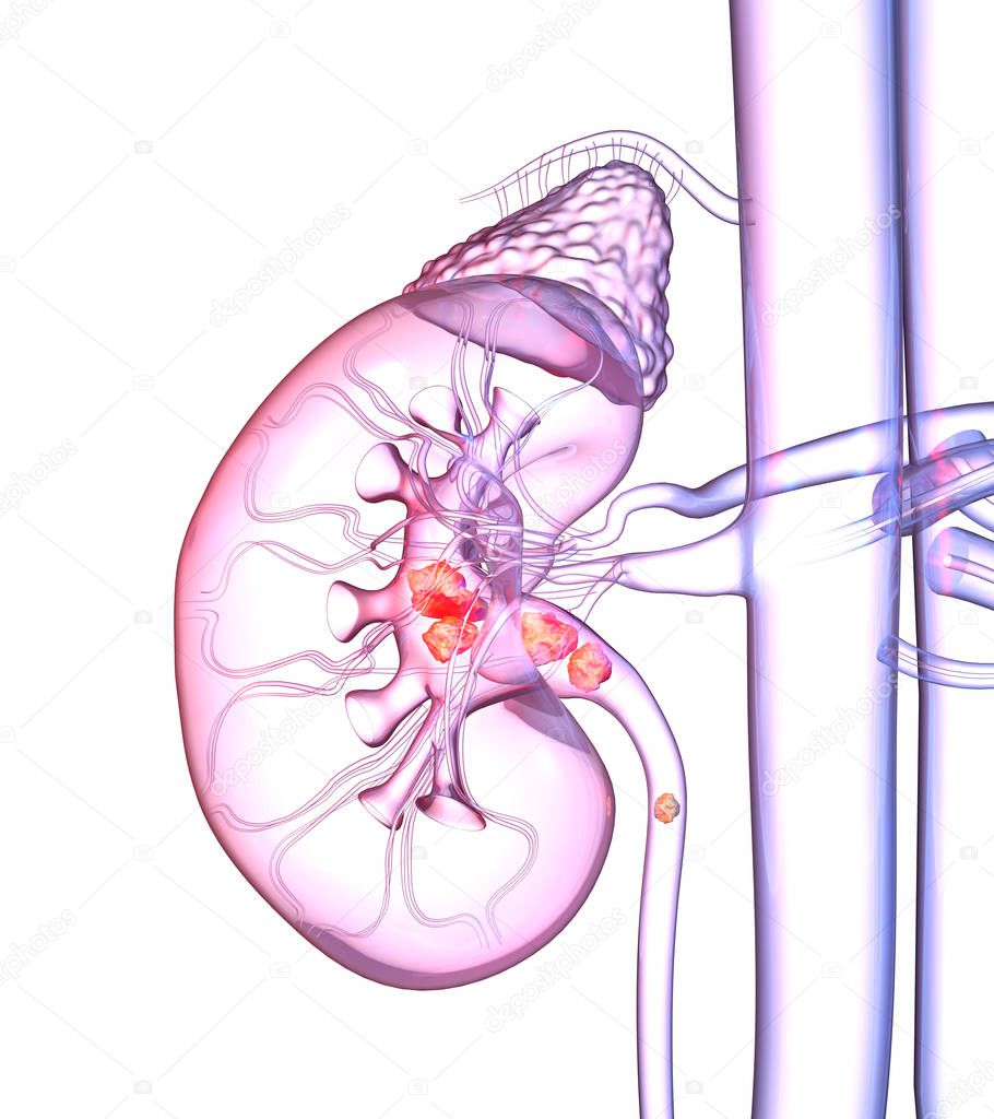 Human kidney with highlighted kidney stones, colorful medically 