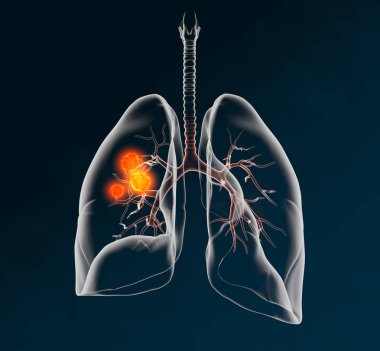 Lung cancer, medically 3D illustration on dark background clipart