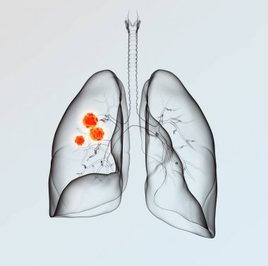Lung cancer, medically 3D illustration on light background clipart