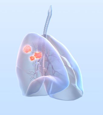 Lung cancer, medically 3D illustration clipart