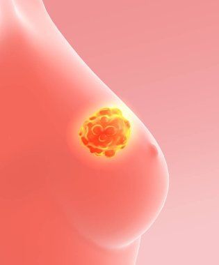 3d illustration showing breast cancer with lymphatics, medically 3D illustration on pink background clipart