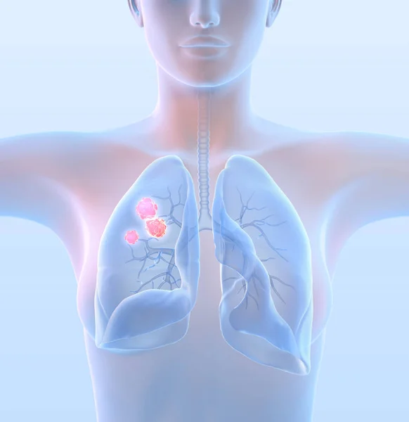 Mujer con cáncer de pulmón, ilustración médicamente 3D en azul claro — Foto de Stock