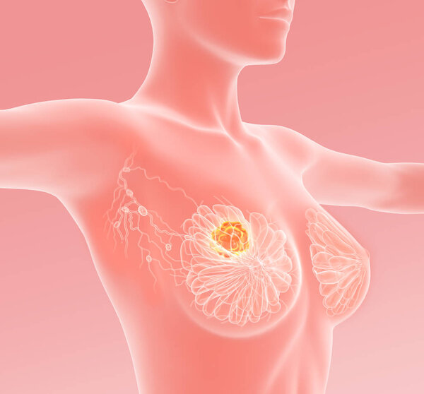 Breast cancer with lymphatics, medically 3D illustration on