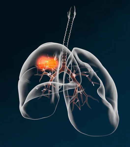Rak płuc, medycznie 3D ilustracji na ciemnym tle niebieskim 3 — Zdjęcie stockowe