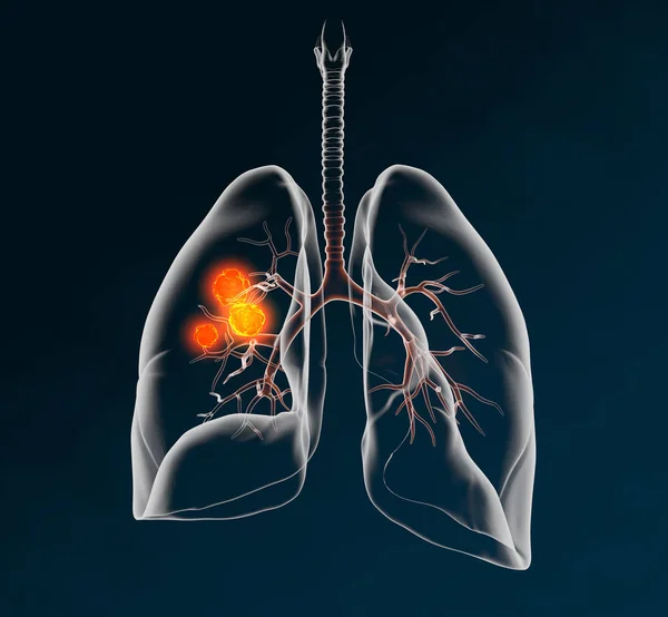 Cáncer de pulmón, ilustración médicamente 3D sobre fondo oscuro — Foto de Stock