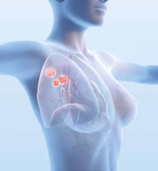 Mujer con cáncer de pulmón, ilustración médicamente 3D en azul claro — Foto de Stock