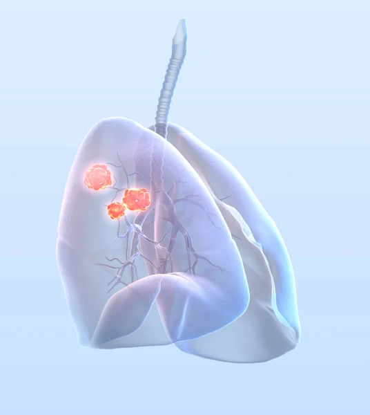 फेफड़े का कैंसर, चिकित्सा रूप से 3 डी चित्र — स्टॉक फ़ोटो, इमेज