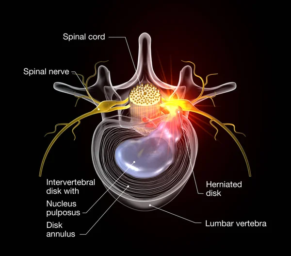 Hernia discal dolorosa, ilustración médicamente 3D en respaldo negro — Foto de Stock