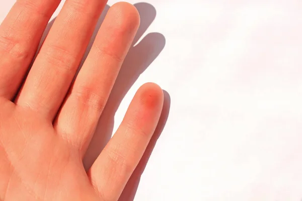 Палець накинутий бджолою. Жіноча рука з укусом комахи, ізольована на білому тлі, копіювати простір . — стокове фото