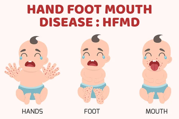Hfmdの子供が感染した 手足口病症状を伴うインフォグラフィック 漫画の健康の概念ベクトル図 — ストックベクタ