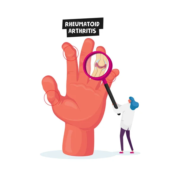 Rheumatoide Arthritis Healthcare. Kleine Arztfigur blickt auf riesige Hand mit entzündeten Fingergelenken Medizincheck — Stockvektor
