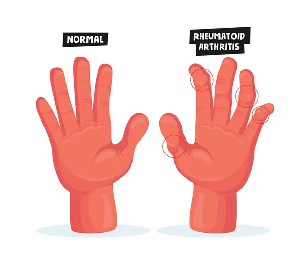 Mãos normais e doentes com artrite reumatoide, osteoartrite. Articulações dos dedos Inflamação Conceito de cuidados médicos. —  Vetores de Stock