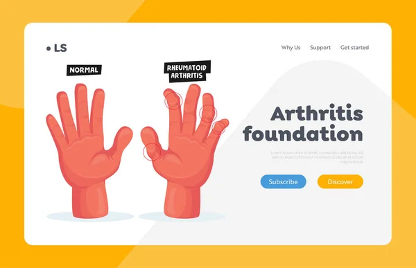 Manos normales y enfermas con artritis reumatoide Plantilla de landing page. Inflamación de las articulaciones del dedo Cuidado de la salud, Tratamiento — Vector de stock