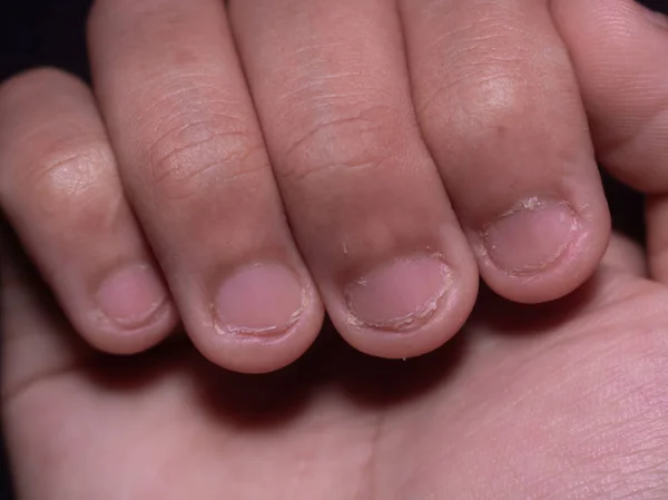 A photo of nails cut by teeth. Nail biting. — Stock Photo, Image
