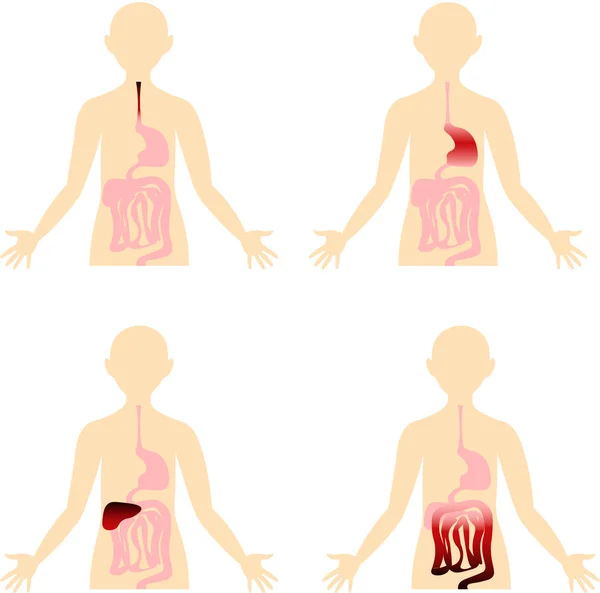 Diseases of the digestive system. Organs of the human body. Anat — Stock Vector