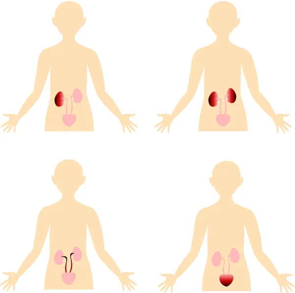 Maladies du système urinaire. Le schéma du corps humain. Anatomes — Image vectorielle
