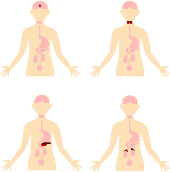 Doenças do sistema endócrino. Esquema do corpo humano. Anat... —  Vetores de Stock