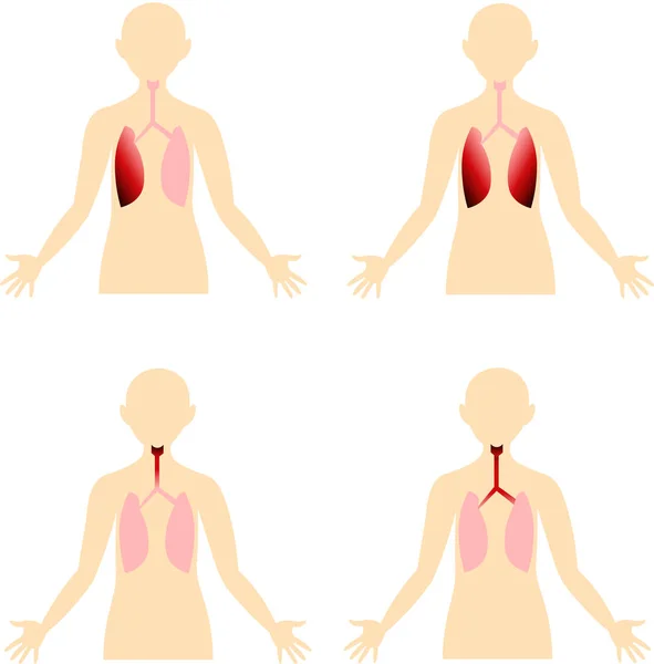 Enfermedades del aparato respiratorio. — Foto de Stock