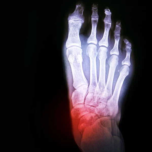 関節の足首または関節炎の脱臼。痛みのスポットの指定と足の X 線 — ストック写真