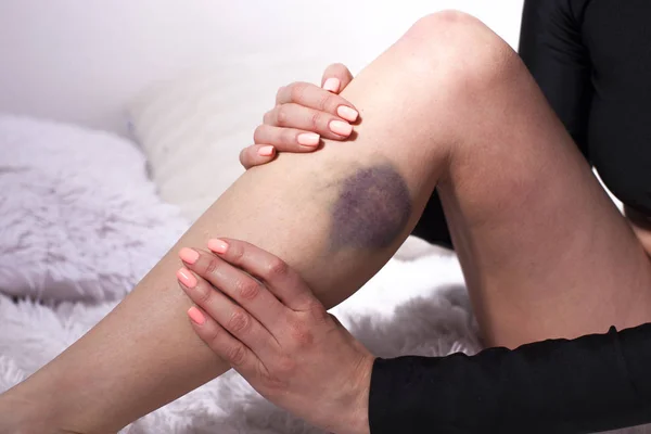 Prellungen Durch Verletzung Weiblichen Bein — Stockfoto