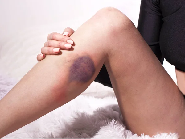 Concept Domestic Violence Bruise Injury Female Leg — Stock Photo, Image