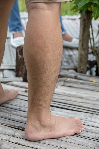 Hairy legs with stains and birthmarks on the skin.