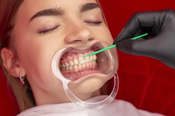 Sbiancamento Dei Denti Ragazza Sulla Procedura Sbiancamento Dei Denti Nello — Foto Stock