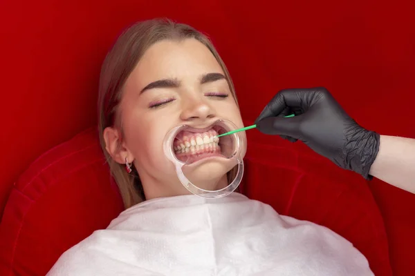 Dentista Procedura Sbiancamento Dei Denti Mette Dente Speciale Sbiancamento Dei — Foto Stock