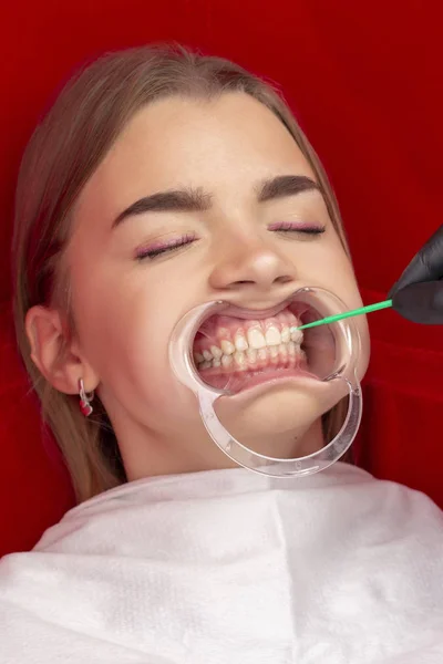teeth whitening procedure dentist puts a special tooth whitening product girl teeth