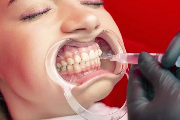 Procedura Sbiancamento Dei Denti Giovane Ragazza Dentista Mettere Candeggina Sul — Foto Stock