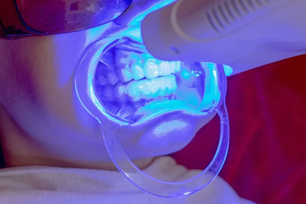 牙齿美白程序紫外线灯美白牙齿女孩嘴延长器 — 图库照片