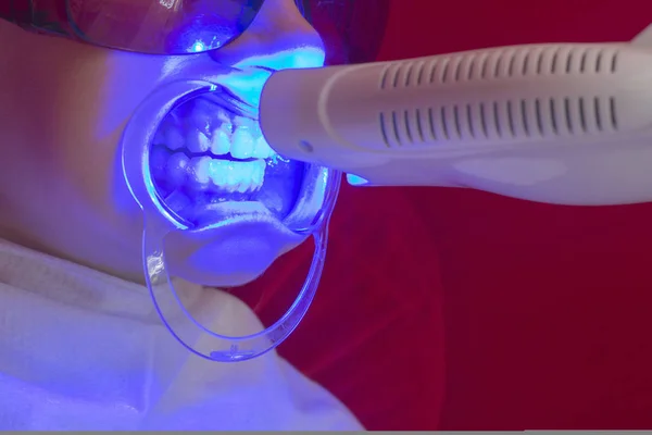 Diş Beyazlatma Işlemi Ultraviyole Lamba Beyazlatma Diş Kız Ağız Uzatıcı — Stok fotoğraf