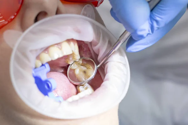 Esame Preventivo Dal Dentista Carie Nel Dente Sulla Parte Superiore — Foto Stock