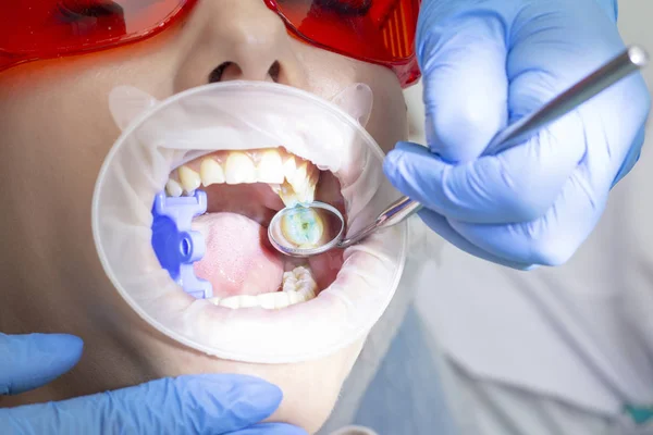 Trattamento Della Carie Una Ragazza Ricevimento Dal Dentista Medico Perforato — Foto Stock