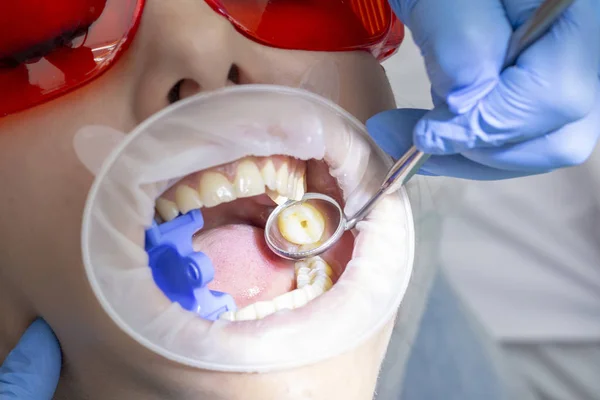 Trattamento Della Carie Una Ragazza Ricevimento Dal Dentista Medico Perforato — Foto Stock